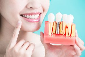 Dental Implant Fixing Services