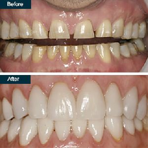 dental veneers treatment