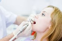 Teeth Scaling Services