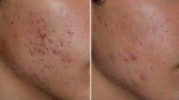 Pimples Treatment