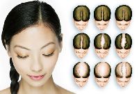 Female Pattern Baldness (Female Hair Loss)