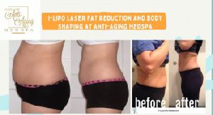 non- invasive laser weight loss treatment in USA