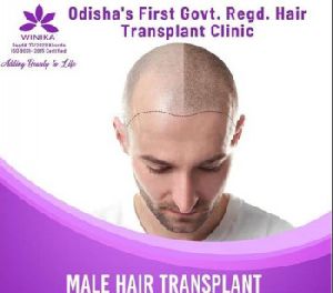 Hair Transplant For Men