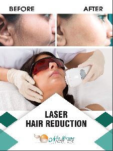 laser hair removal services