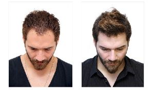 growuphairtransplant