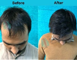 hair transplantation service