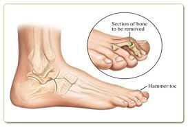 Hammer Toes Treatment