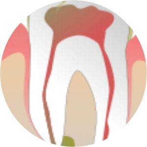 Single Sitting Root Canal Treatment Services