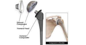 Total Shoulder Replacement Services