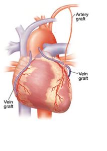Multi Vessel Coronary Artery Bypass Surgery Services