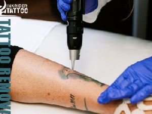 tattoo removal services