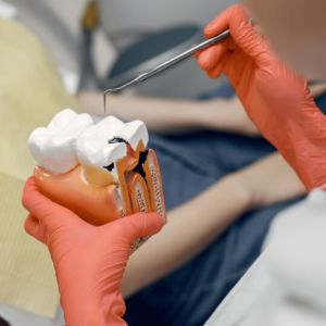 root canal treatment service