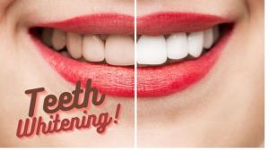 Tooth Whitening Services