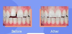 Dental Veneers