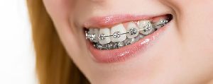 Braces / Orthodontics Treatment