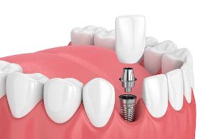 DENTAL IMPLANTS