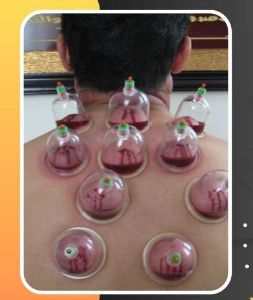 Hijama Sunnah Dates Cupping Therapy
