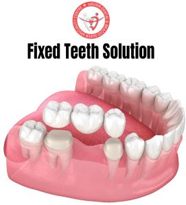 fixed teeth solution