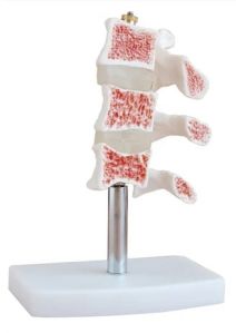 Osteoporosis Bone Joint Model