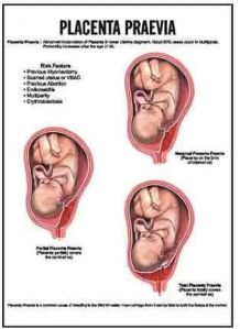 Placenta Praevia Chart