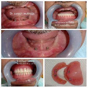 Implant Supported Denture