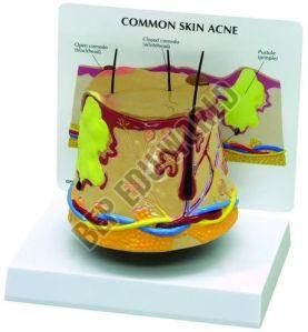 PP Acne Skin Model For Medical College