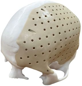 3D Cranioplasty Implant Peek