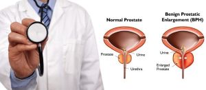 Prostate Enlargement Medicine