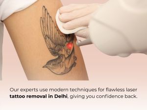 Laser Tattoo Removal Treatment