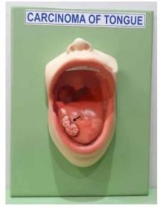 Plastic Carcinoma Tongue Pathology Model