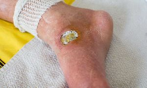 Arterial Ulcers Online Consultant