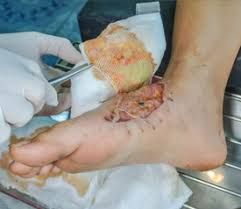 Infectious Wounds Online Consultation