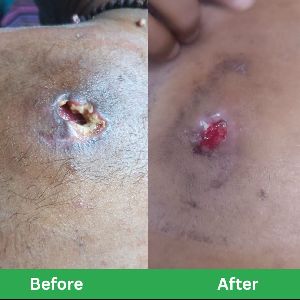 Pressure Ulcers (Bedsores) Online Consultation