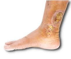 Venous Leg Ulcers Online Consultation in India