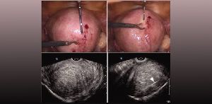 Hypogonadism Treatment