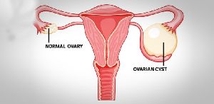Ovarian Cysts Treatment