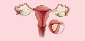 Uterine Cancer Treatment