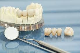 Dental Crown Bridges
