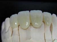 Dental Ceramic Bridges