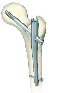 Orthopedic Trauma Implants