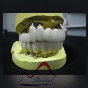 Dental Implant