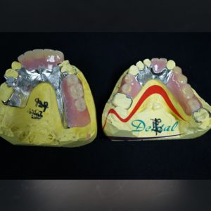 Removable Denture