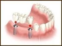 Artificial Teeth Sets