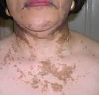 vitiligo treatment services