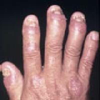 Psoriatic Arthritis treatment