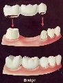 Dental Bridge Treatment Services