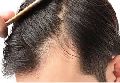 Ctrl+Z Hair loss Treatment