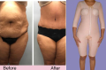 Liposuction Compression Garment