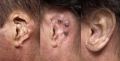 Evolution Health Care Plain silicone ear prosthesis
