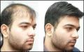 Mens Non Surgical Hair Replacement  Services